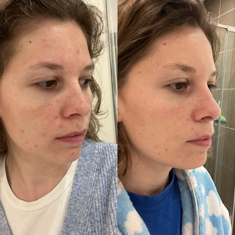 Before & After van een vrouw die Bbody Collageen poeder + Vitamince C heeft gebruikt. Verstevigende supplementen voor een gezonde huid, haar en nagels, met antioxidanten voor optimale huidverjonging.