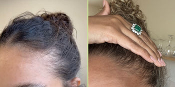 foto van kale plek en voller haar door haaruitval